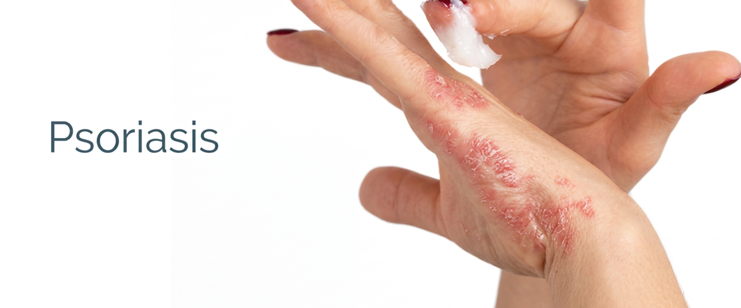 Psoriasis