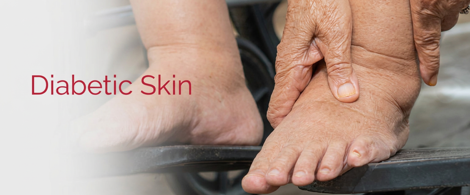 Diabetic Skin