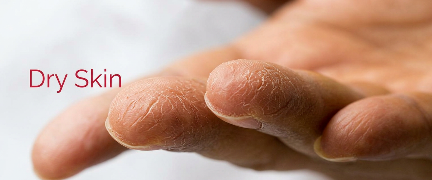 Dry Skin