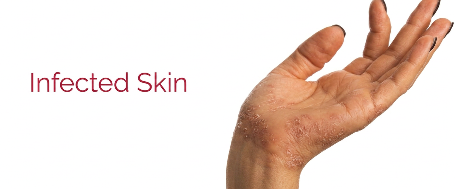 Infected Skin