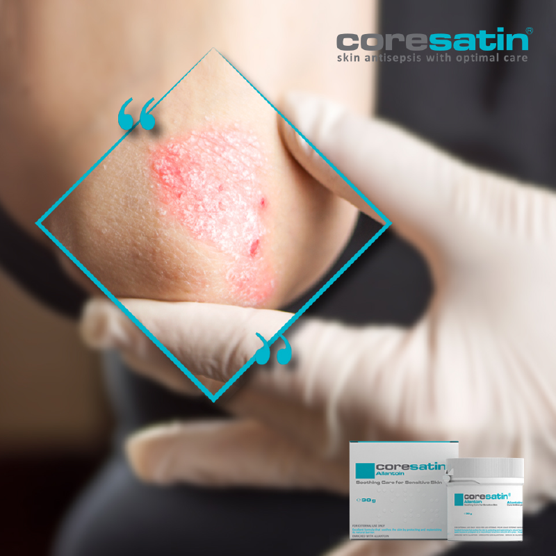 Allantoin Soothing Care for Sensitive Skin